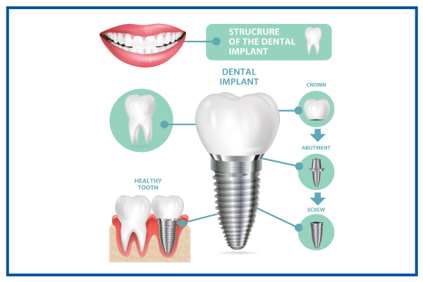 Pic of Dental-implant structure in solihull Clinic